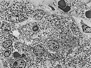 M, 23y. | acidophilic pituitary adenoma (STH) M, 23y. | acidophilic pituitary adenoma (STH)